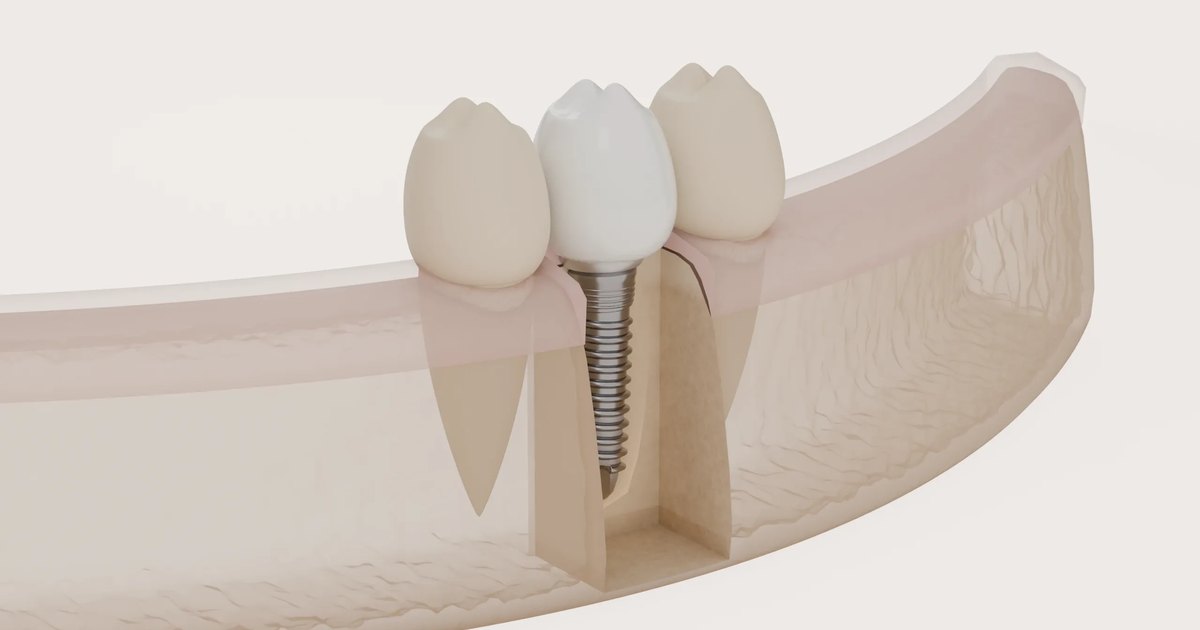 Illustration of a dental implant and replacement tooth